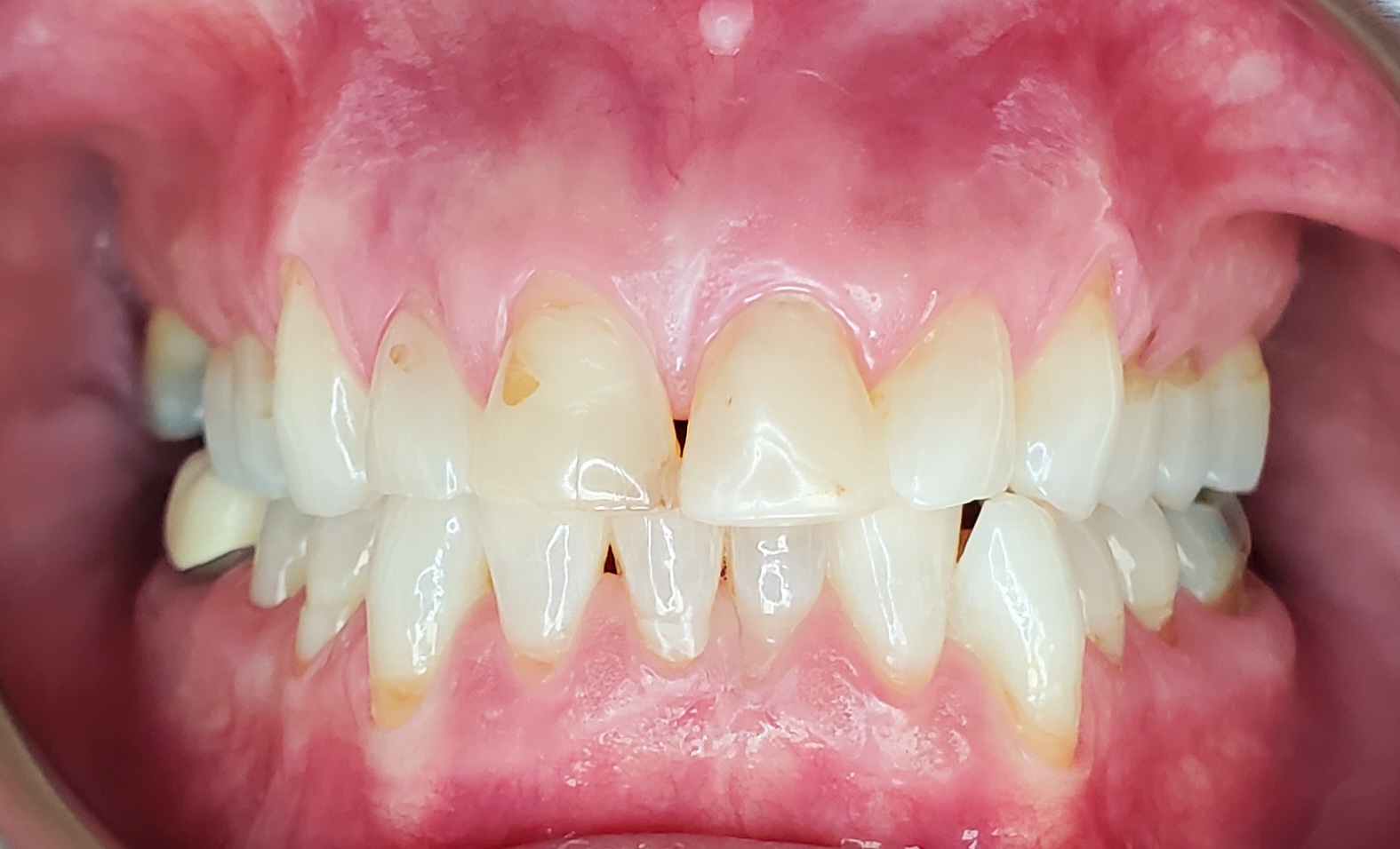 Cosmetic dentistry before treatment at Elm Ridge Implant and Family Dentistry in Killeen, TX